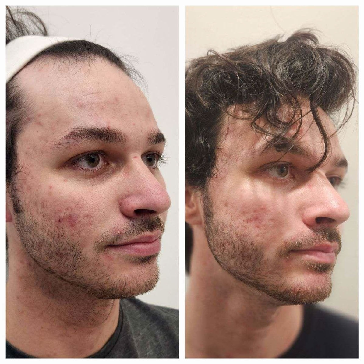 Acne Before and After (2)