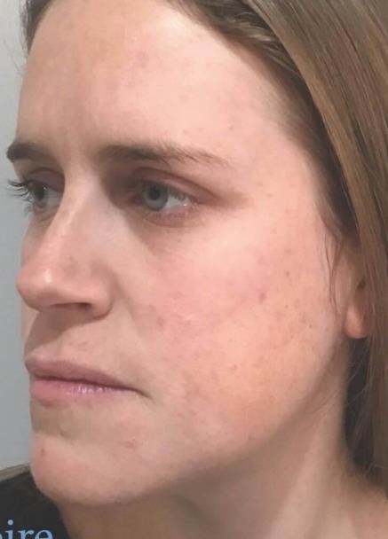 Melasma After (1)