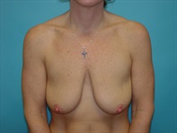 Dr. Serra Surgical Before & After