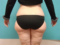 Dr. Serra Surgical Before & After