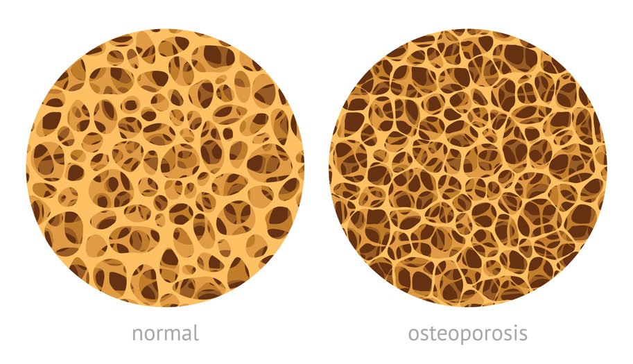 Image showing the structure of a normal bone versus one damaged by osteoporosis.